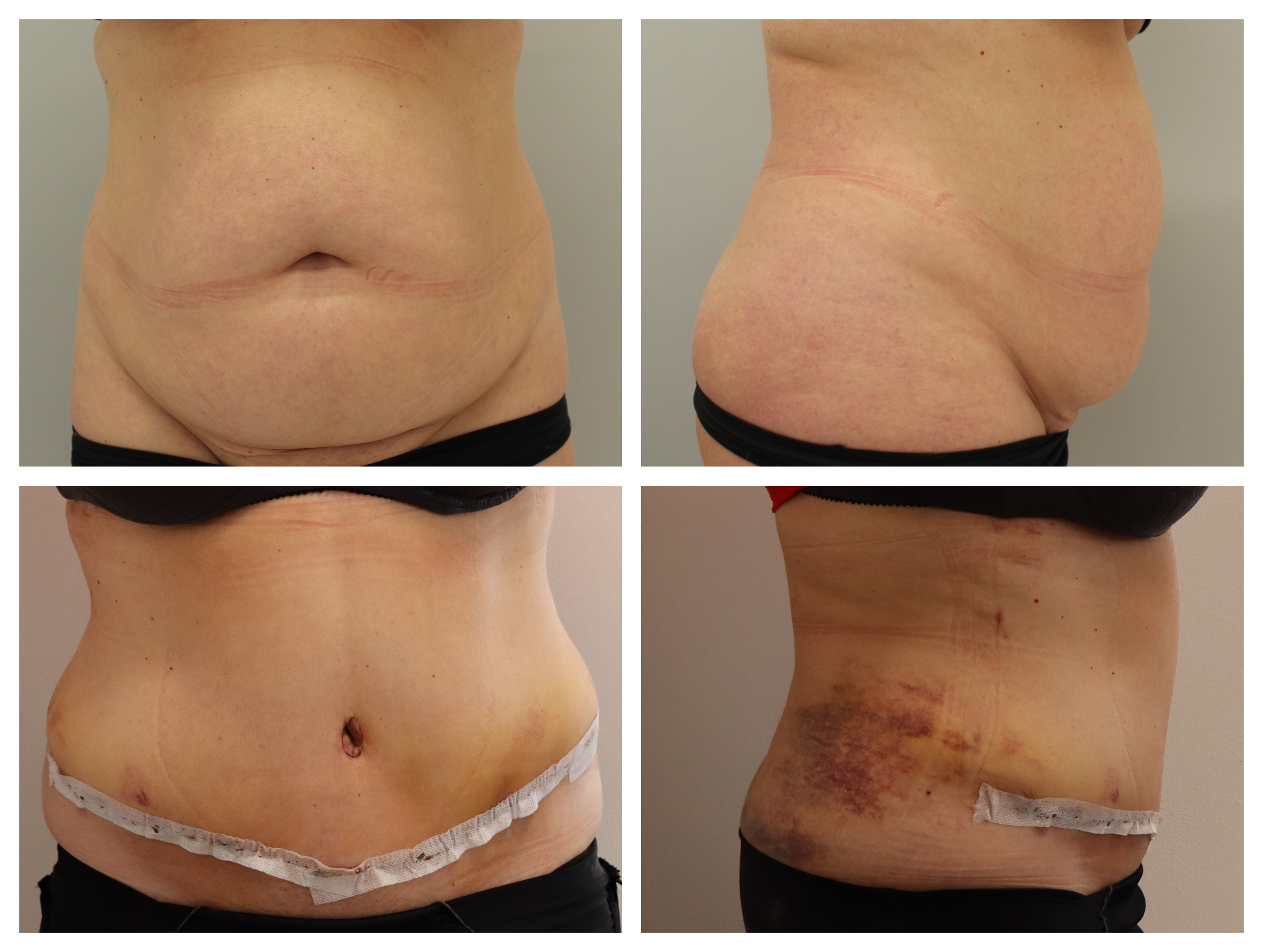 Abdominoplastika