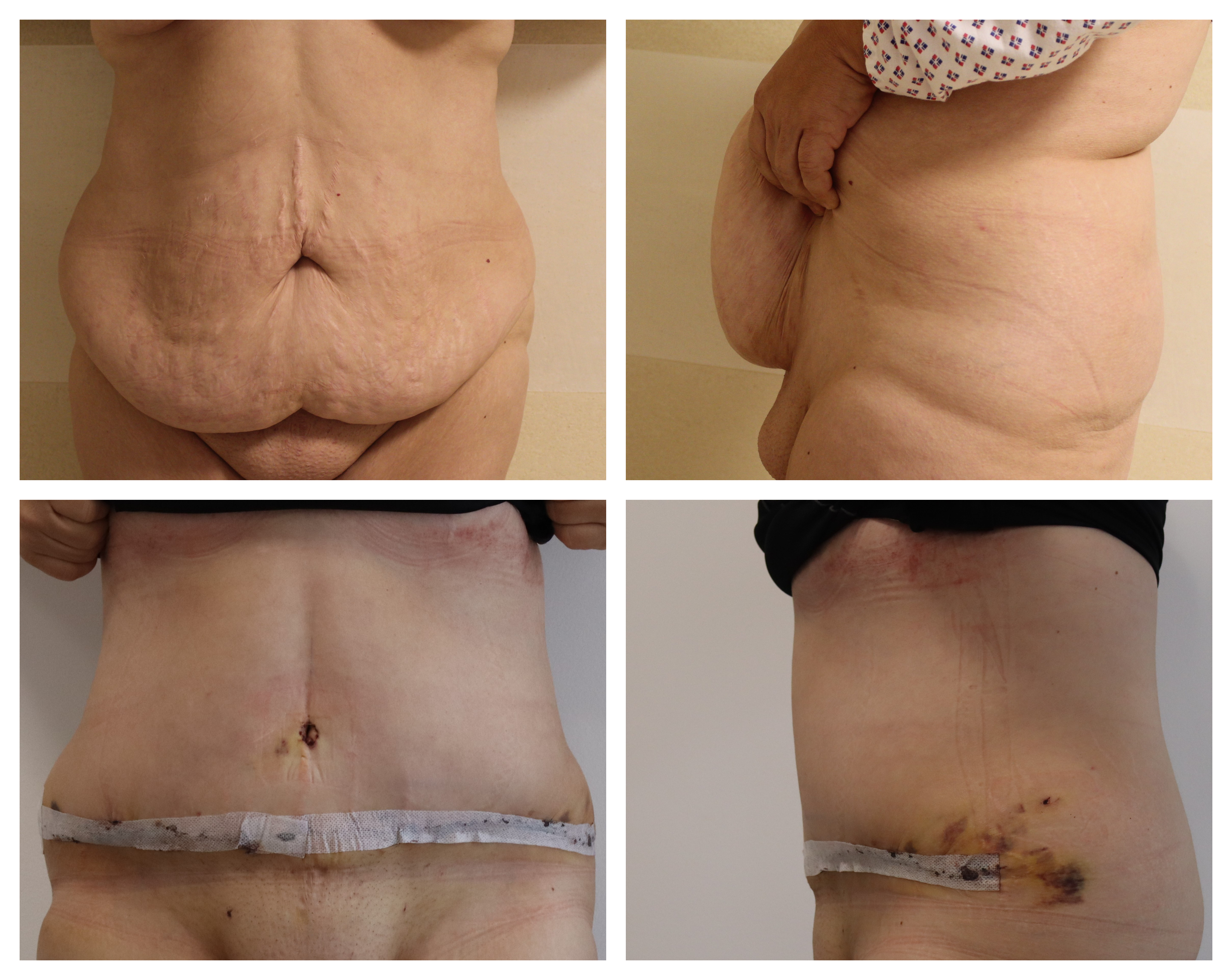 Abdominoplastika