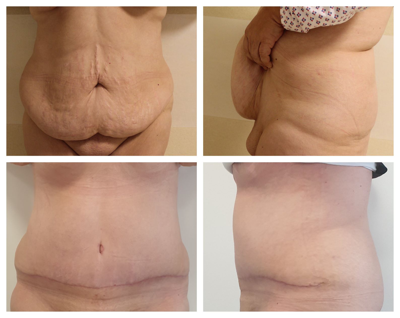 Abdominoplastika