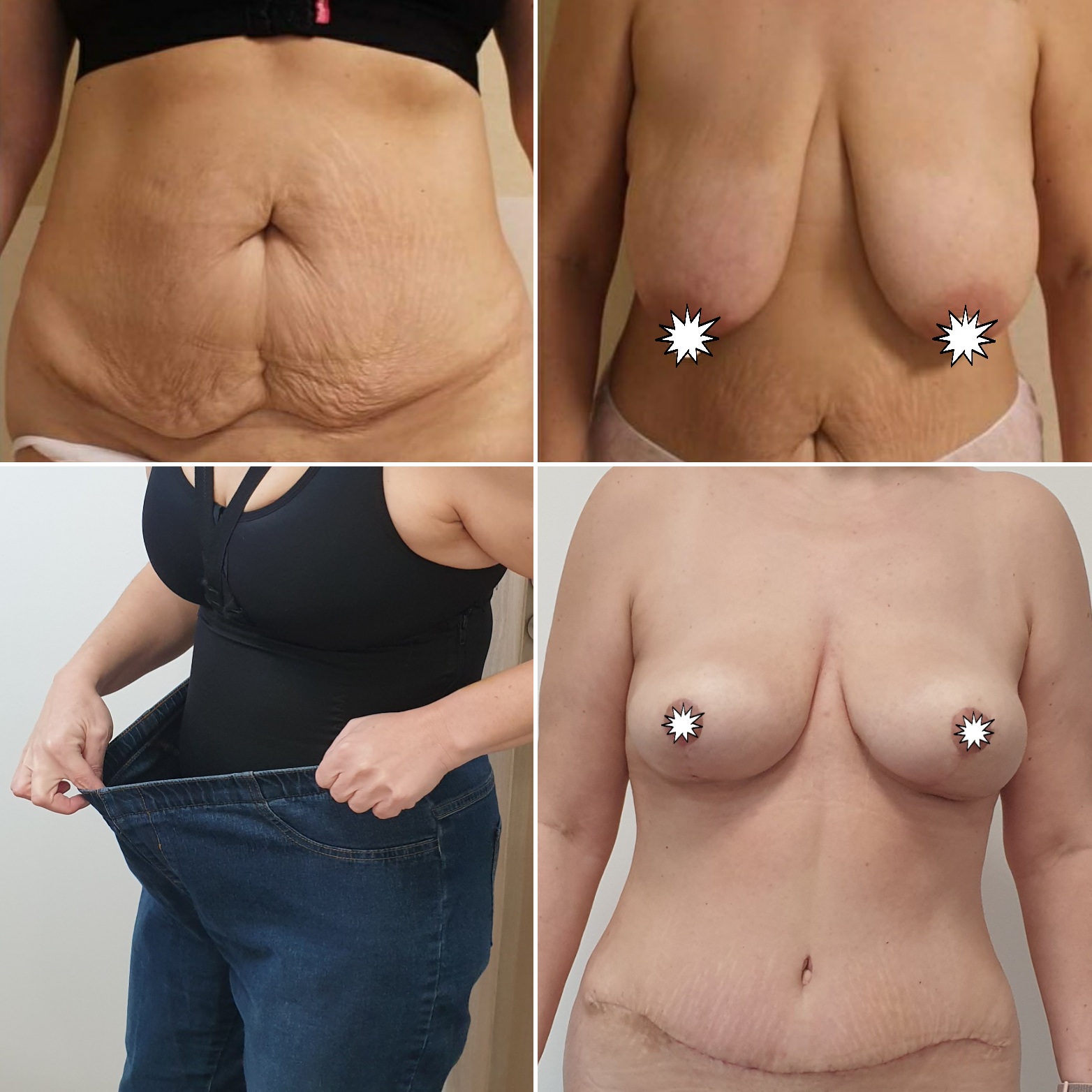 Abdominoplastika, modelace