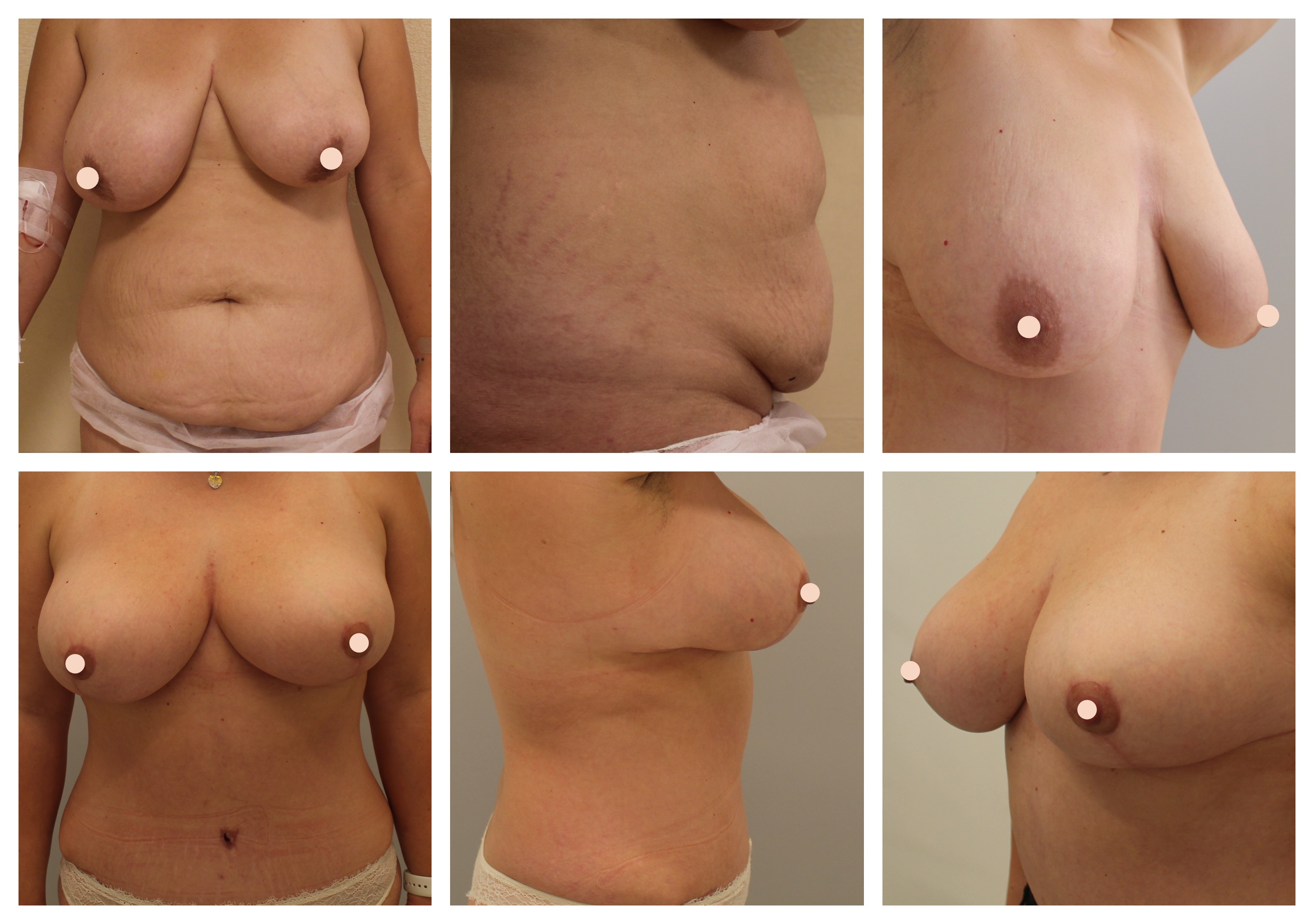 Abdominoplastika, modelace - Poděbrady