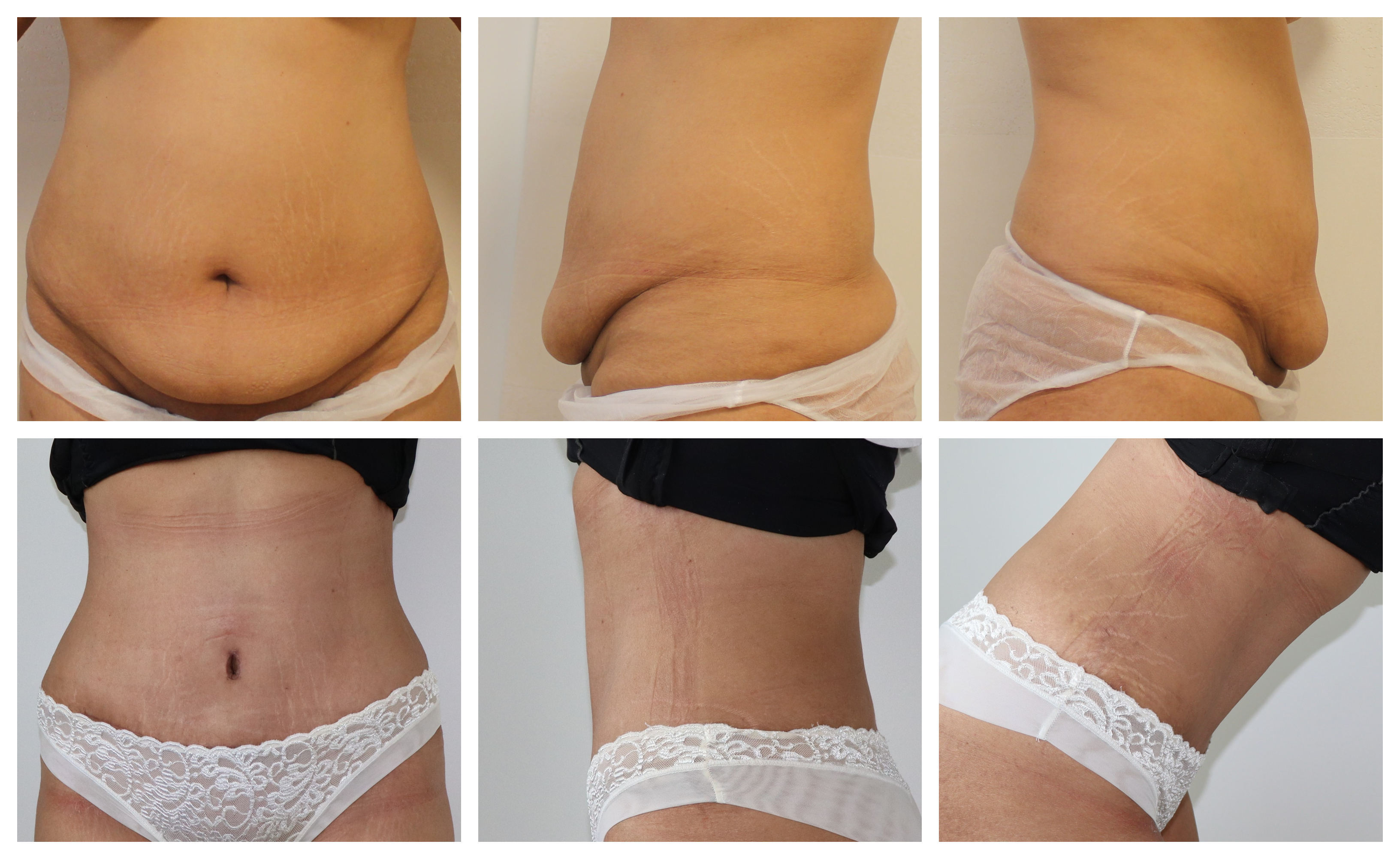 Abdominoplastika - Poděbrady Dr. Veliký