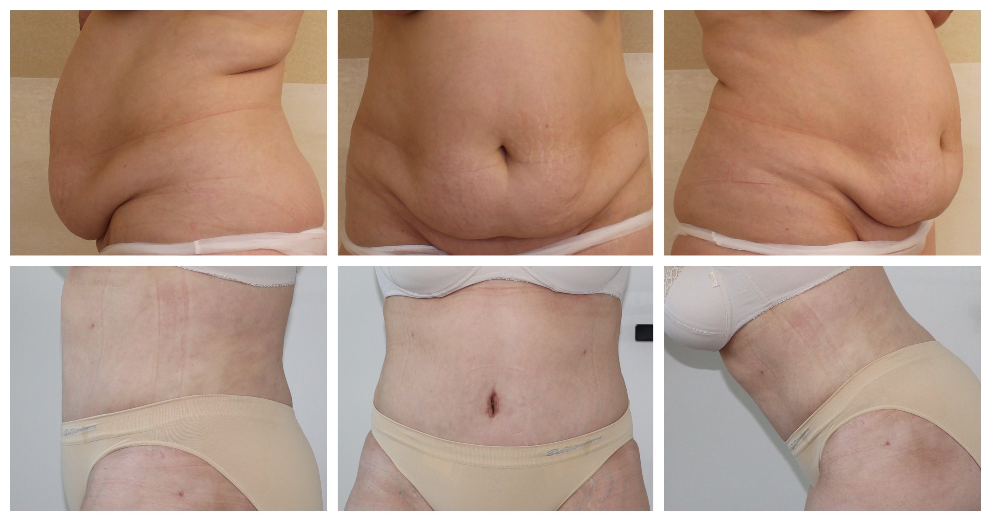 Abdominoplastika Poděbrady