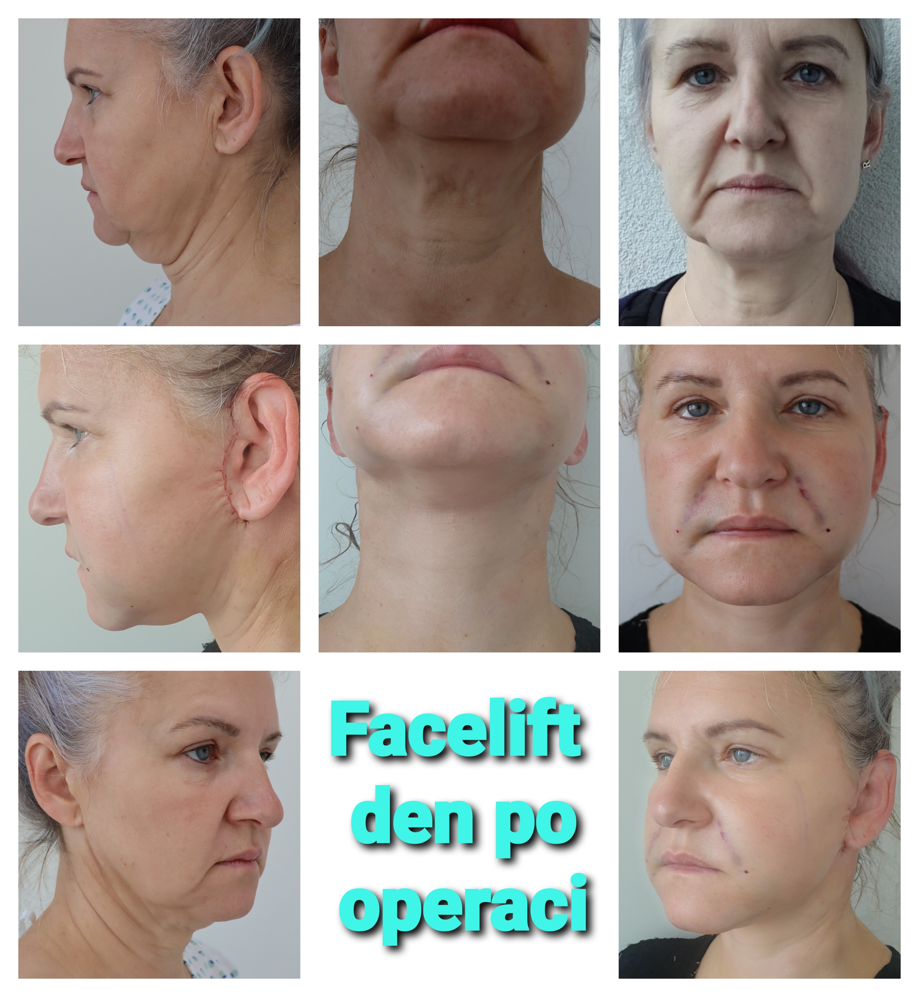 Facelift 