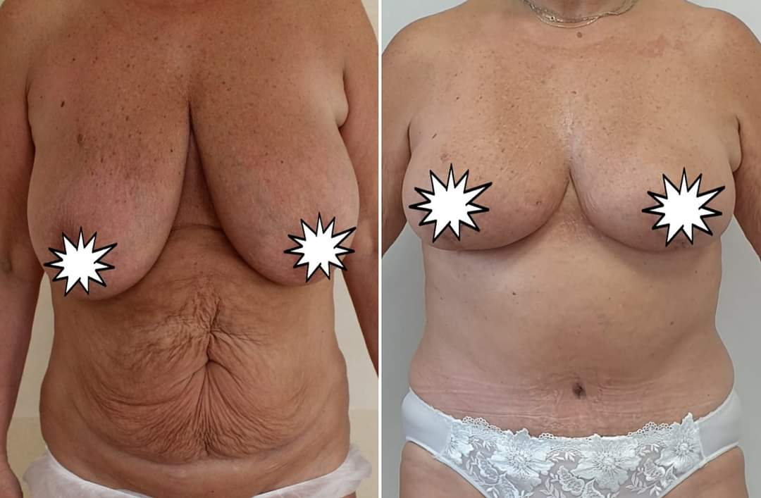 Abdominoplastika, redukce prsou