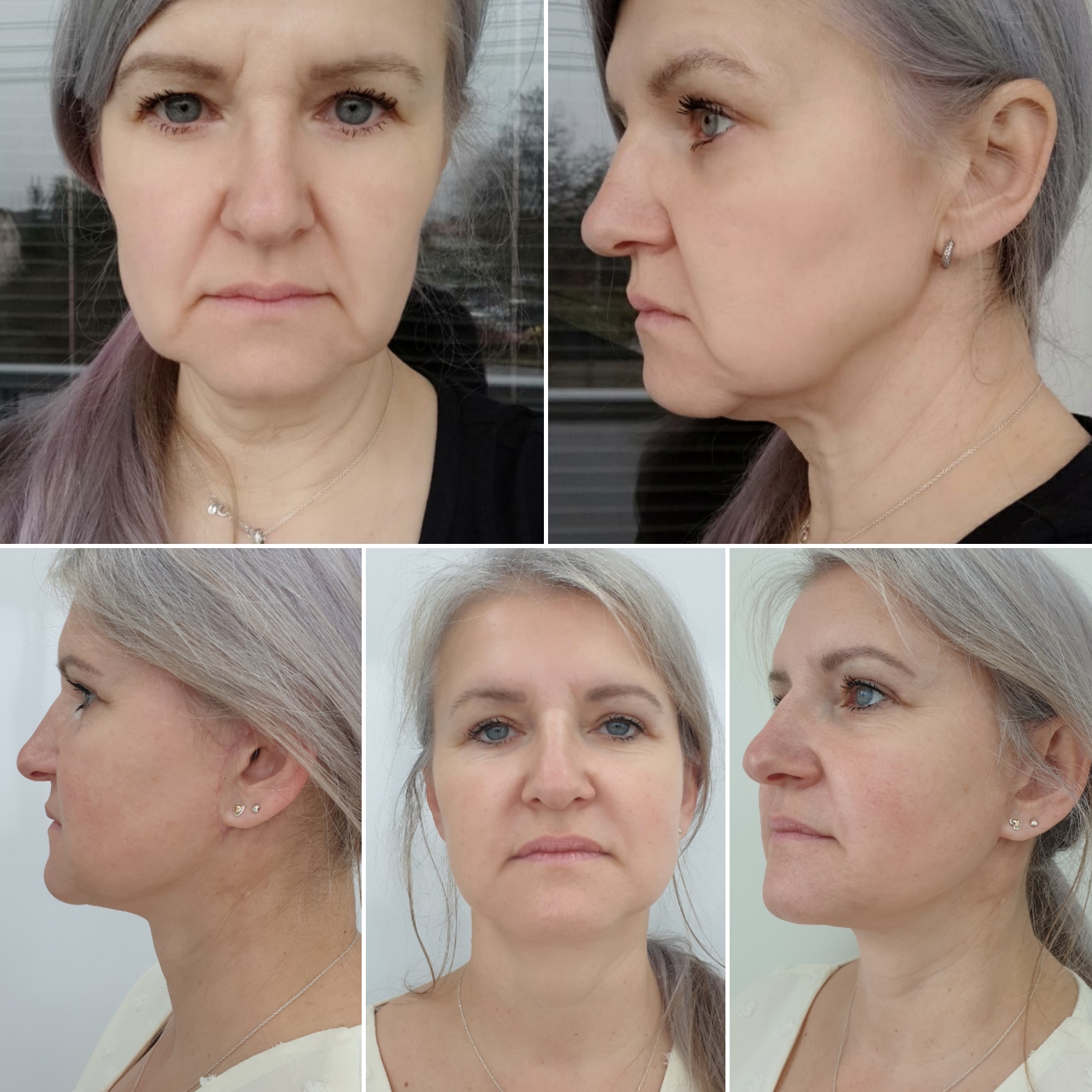 Facelift - lifting obličeje