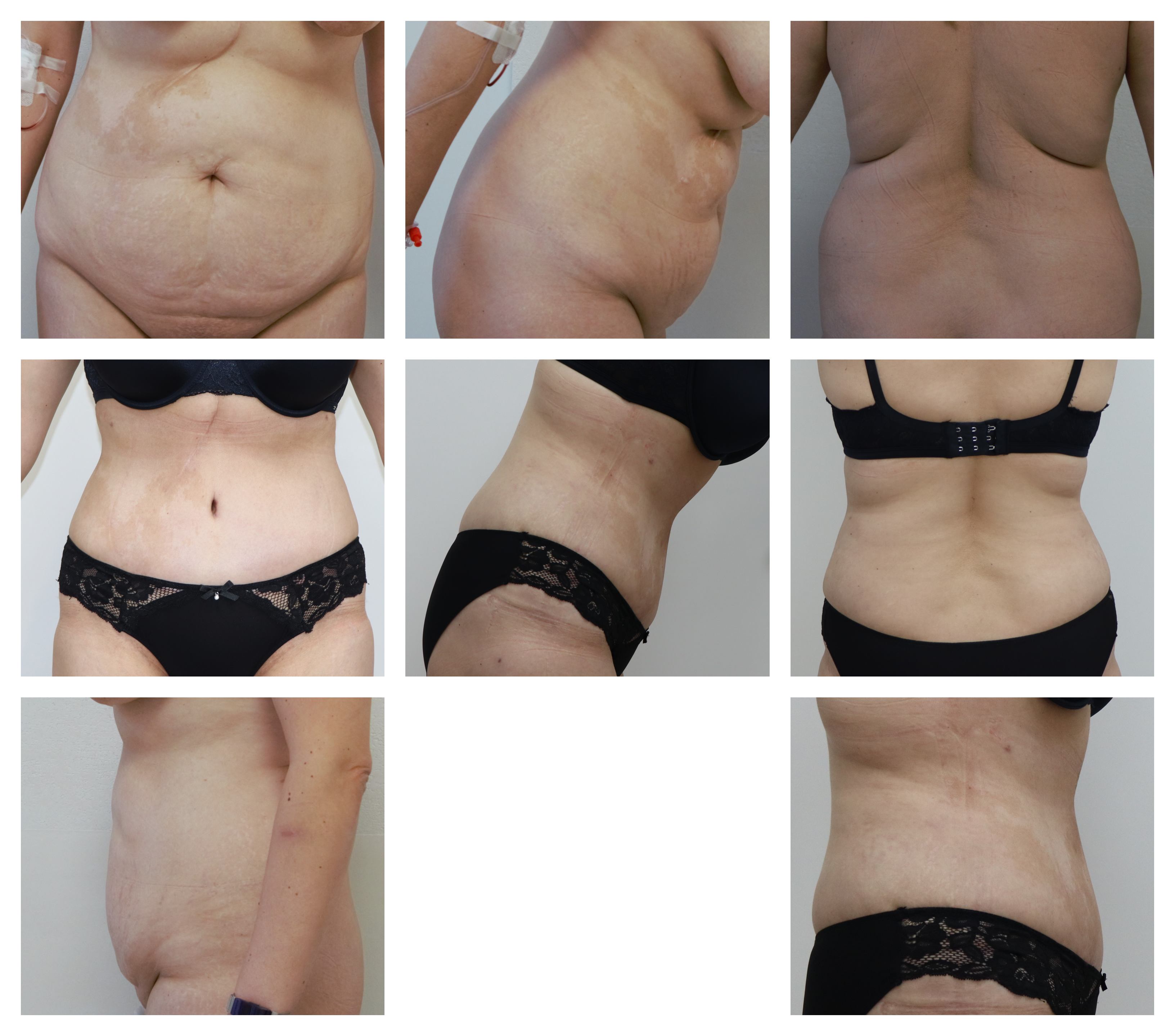 Abdominoplastika