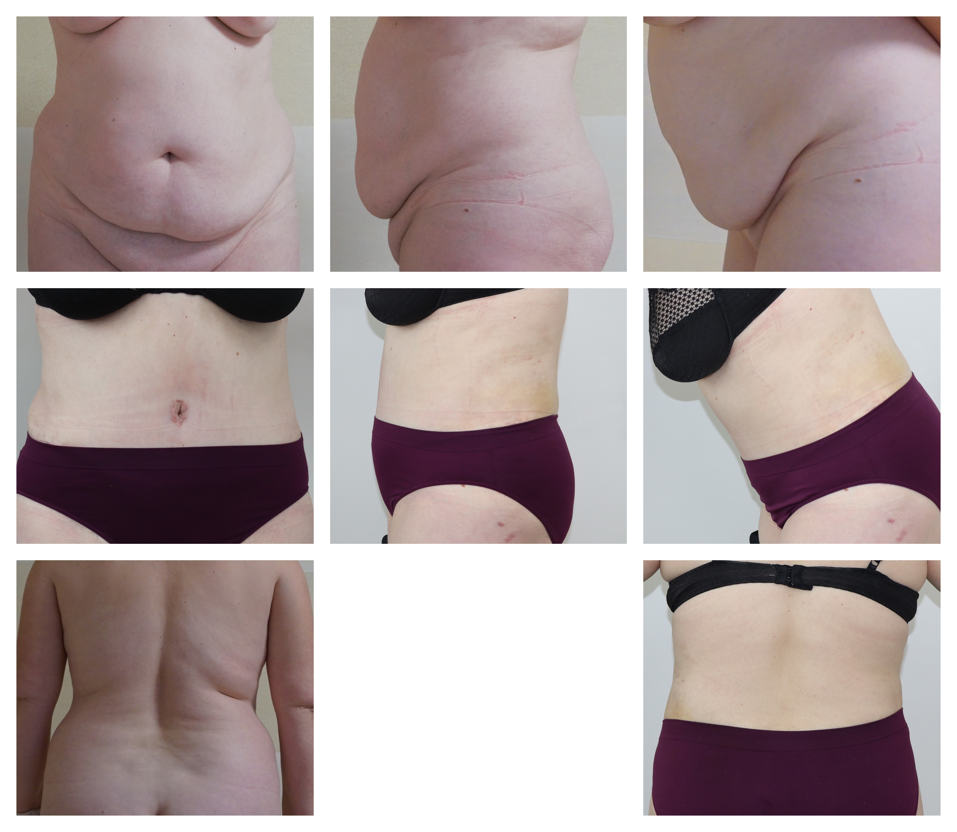 Abdominoplastika Dr. veliký