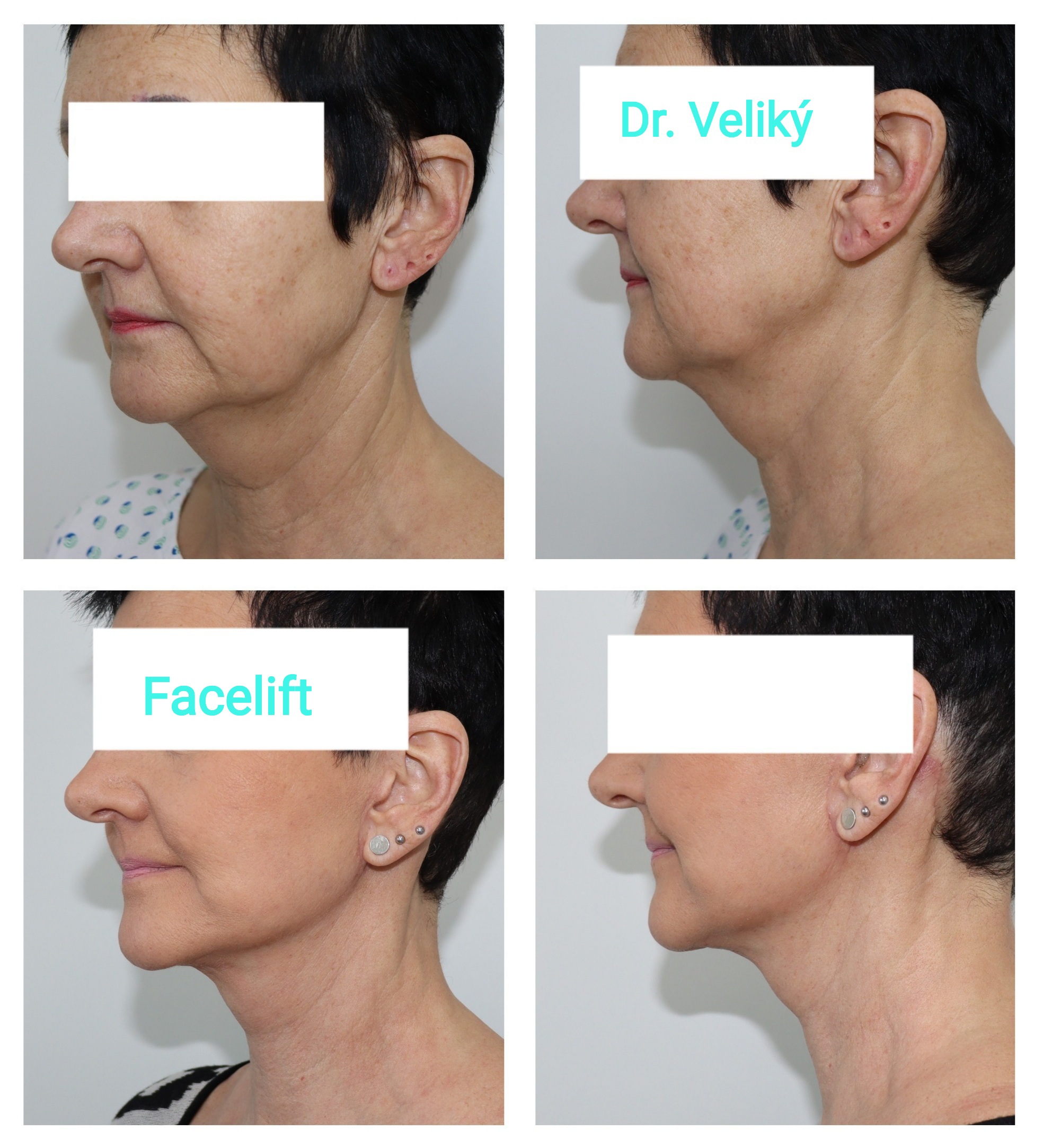 Facelift Dr. Veliký