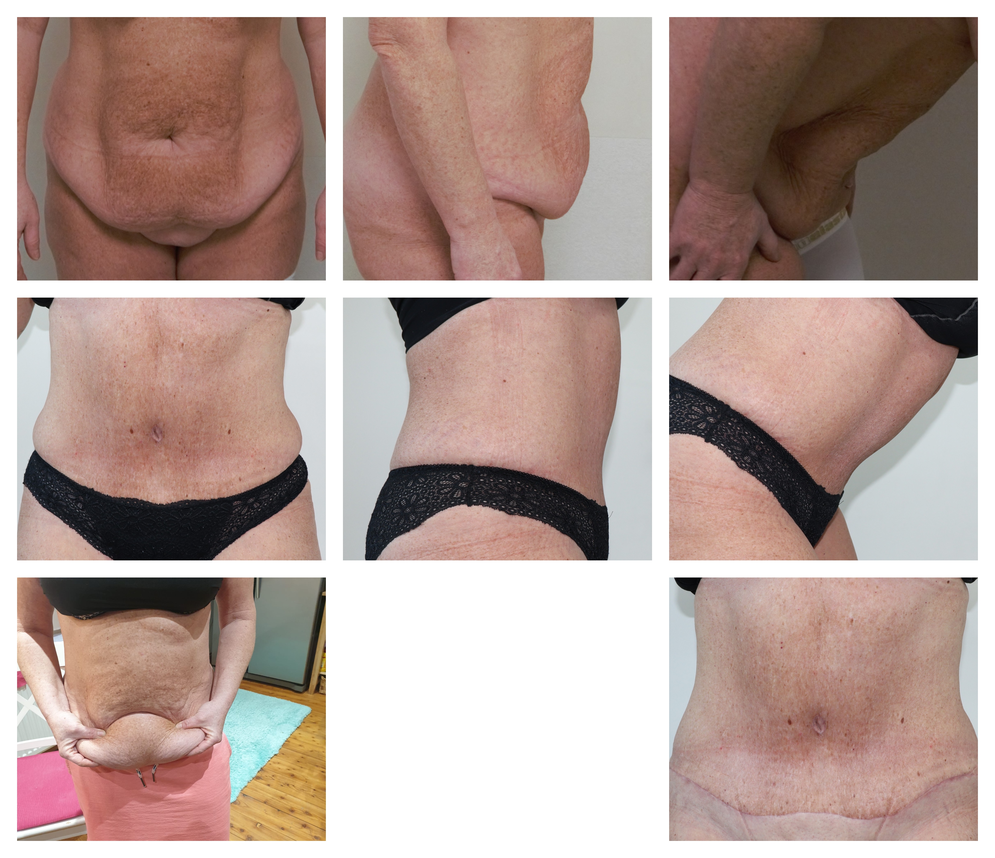 Abdominoplastika Dr. Veliký