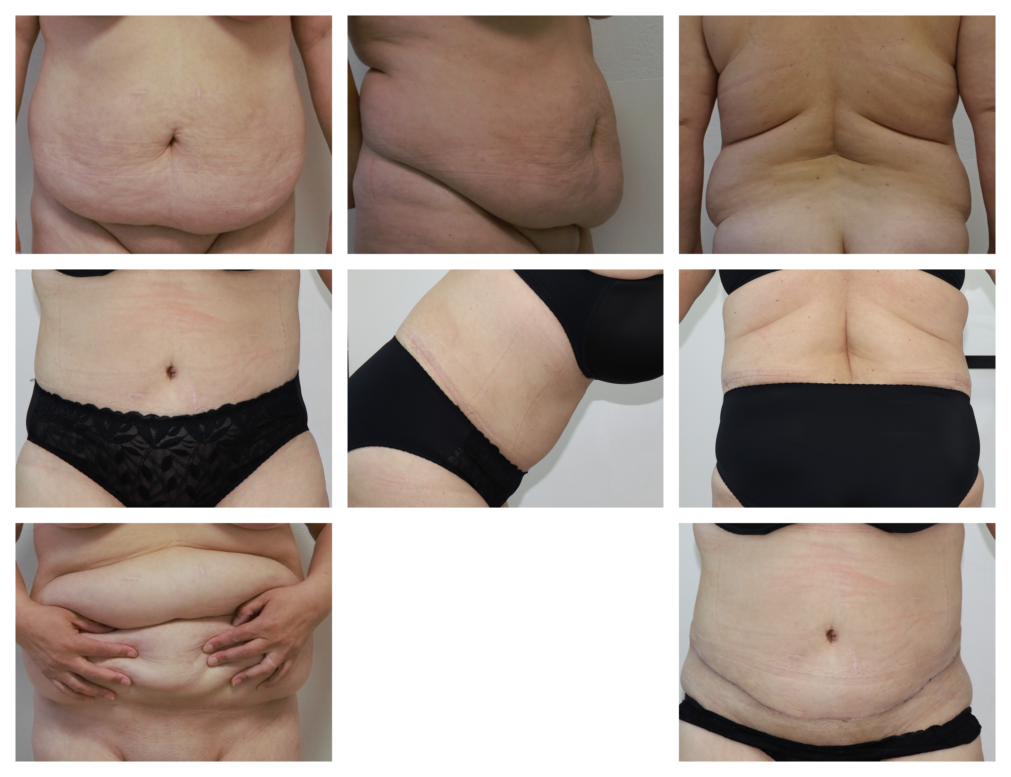 Abdominoplastika Dr. Veliký