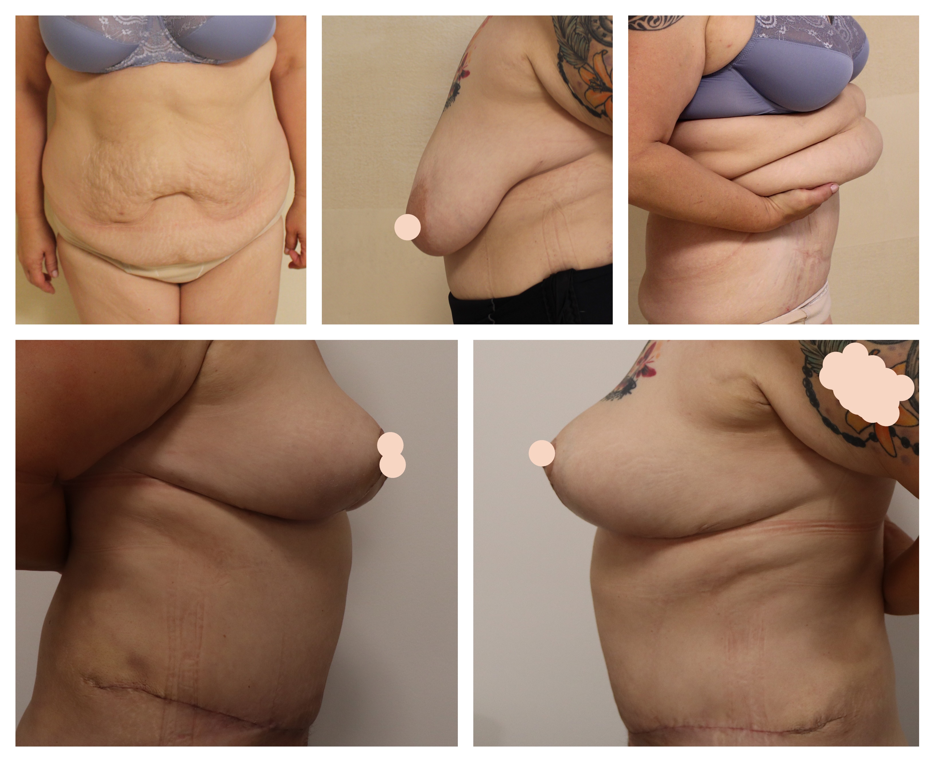 Abdominoplastika, modelace