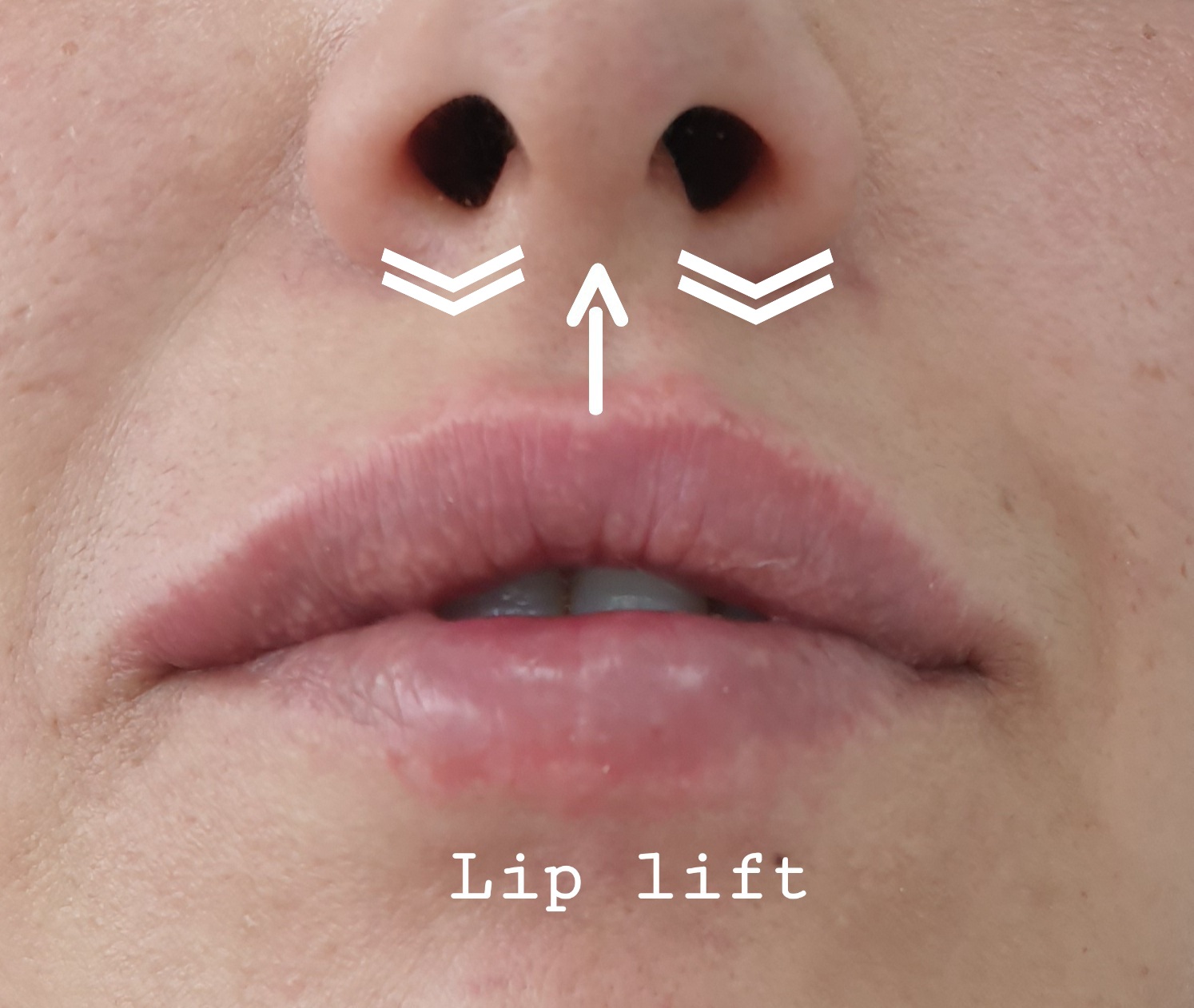 Lip lift - bullhorn lip lift