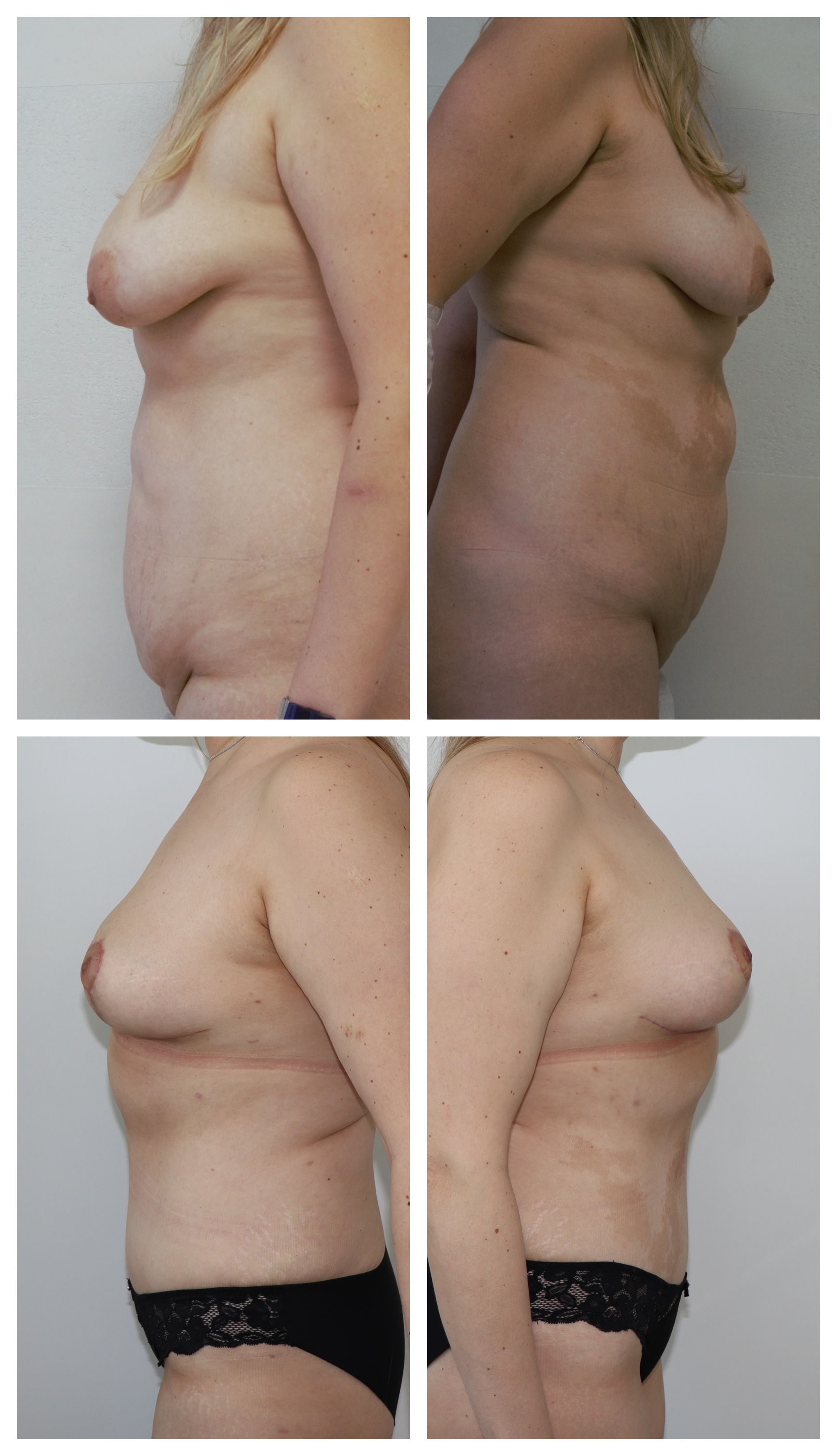 Abdominoplastika, modelace prsou