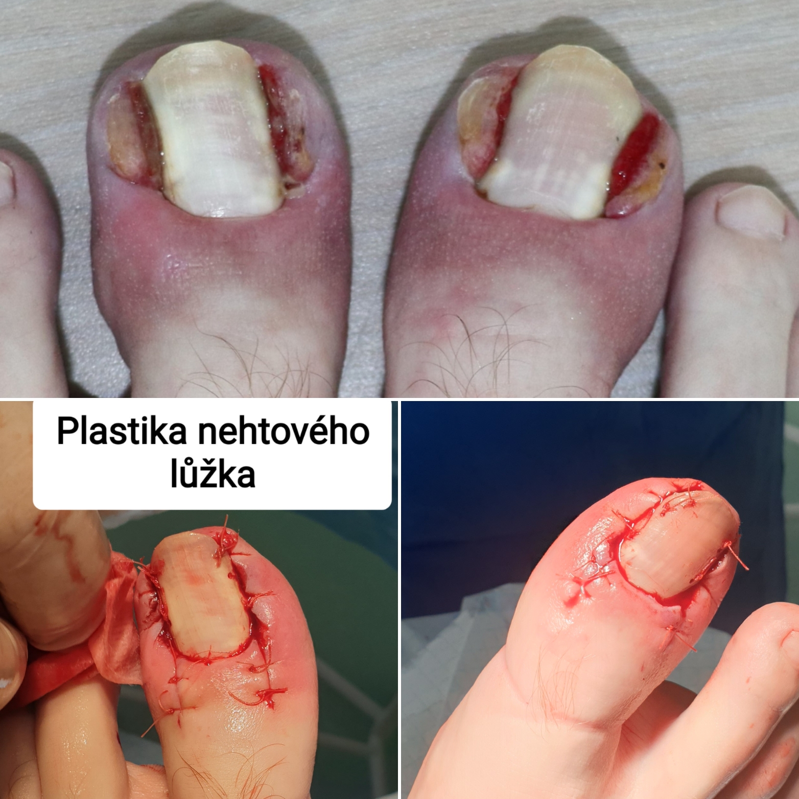 Plastika nehtového lůžka - léčba zarostlých nehtů