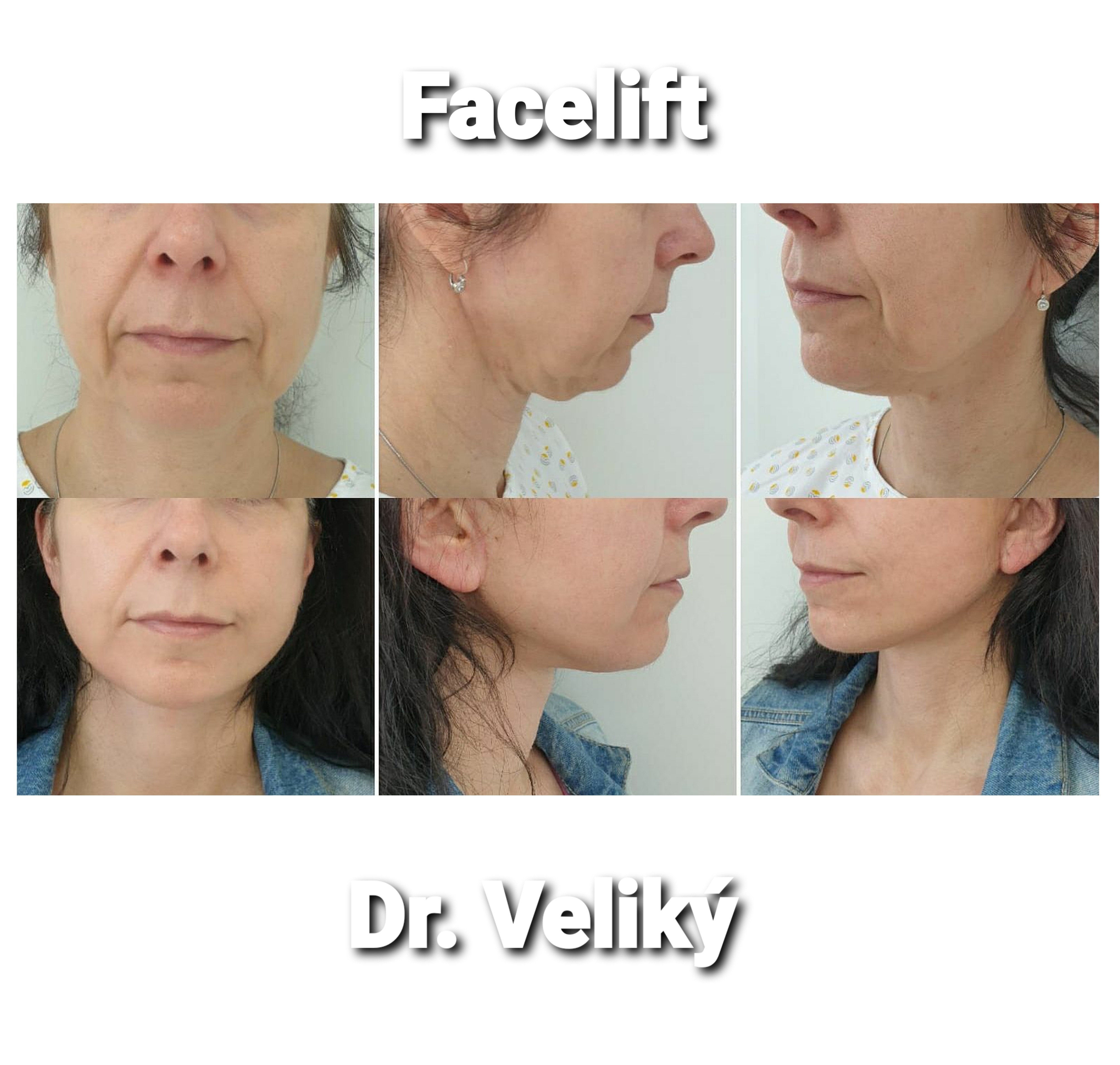 Facelift - lifting obličeje