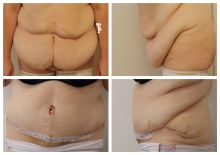 Abdominoplastika 14 dní po operaci