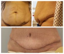 Abdominoplastika - měsíc po operaci