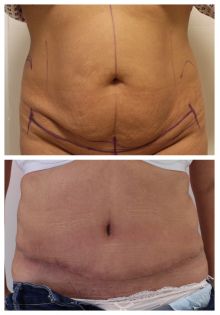 Abdominoplastika - 3 týdny po operaci