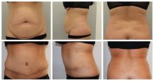 Abdominoplastika 5 týdnů PO