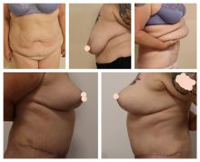 Abdominoplastika + modelace