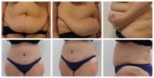 Abdominoplastika