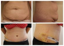 Abdominoplastika 1 týden po operaci