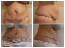 Abdominoplastika týden po operaci