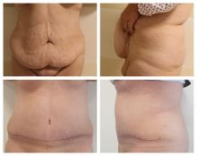 Abdominoplastika po 2 měsících