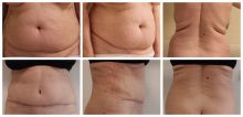 Abdominoplastika měsíc PO