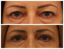 Blepharoplastika Poděbrady - horní a spodní víčka