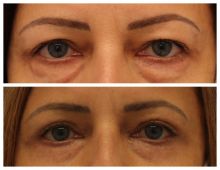 Blepharoplastika Poděbrady - horní a spodní víčka