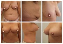 Abdominoplastika, modelace prsou