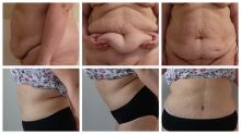 Abdominoplastika