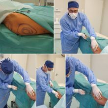 Liposukce - Plastická chirurgie Poděbrady