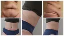 Operace břicha - abdominoplastika