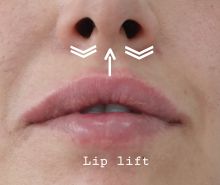 Lip lift - lifting rtů