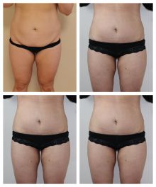 Miniabdominoplastika a liposukce vnitřních stehen