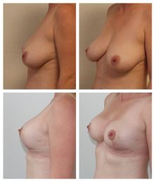 Modelace prsou po 6 týdnech
