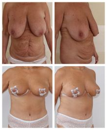 Abdominoplastika, redukce prsou - Proměna