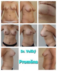 Abdominoplastika, modelace