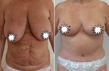 Abdominoplastika s redukcí prsou
