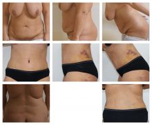 Abdominoplastika Dr. Veliký