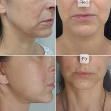 Facelift, tattransfer Dr. Veliký