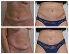 Abdominoplastika