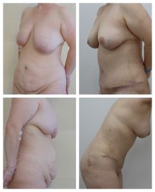 Abdominoplastika a redukce prsou