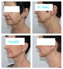 Facelift - lifting obličeje Dr. Veliký