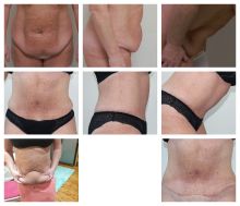 Abdominoplastika Dr. Veliký - měsíc po operaci