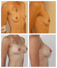 Augmentace, zvětšení prsou - Dr. Veliký