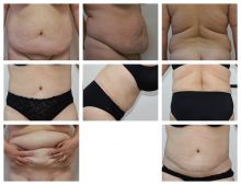 Abdominoplastika 6 týdnů po operaci Dr. Veliký